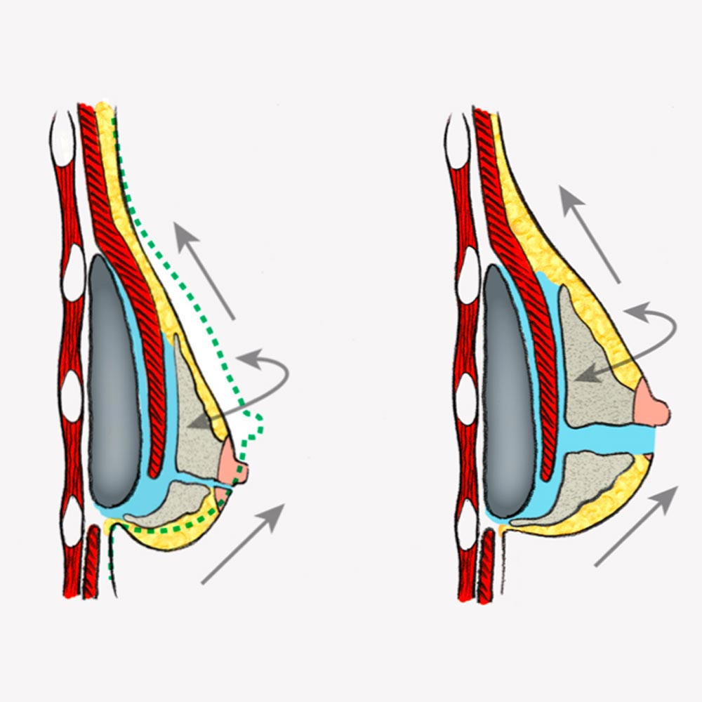 Dual plane